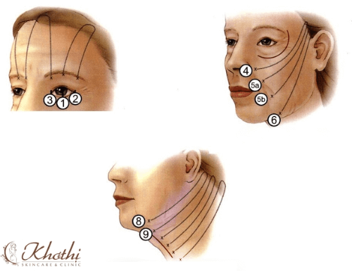 Xóa nhăn nhờ phá hỏng cấu trúc nếp gấp dưới da