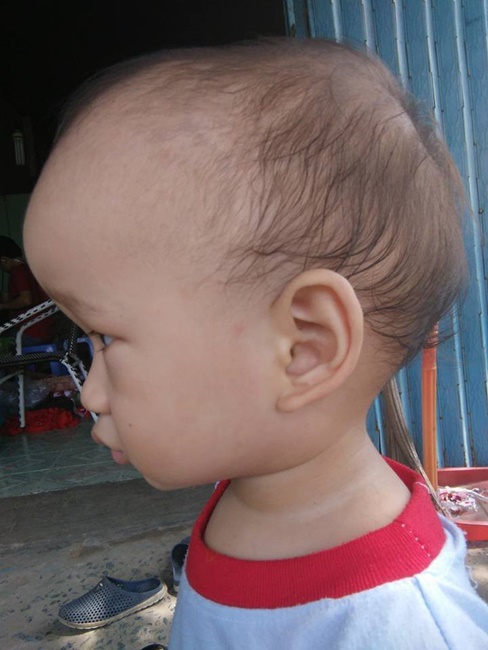 Em bé 18 tháng tuổi mắc bệnh dị tật bẩm sinh não cần sự giúp đỡ