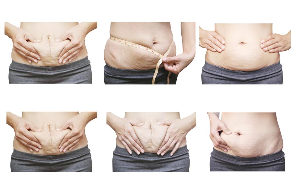 Giải quyết ám ảnh về mỡ bụng cho phụ nữ sau sinh
