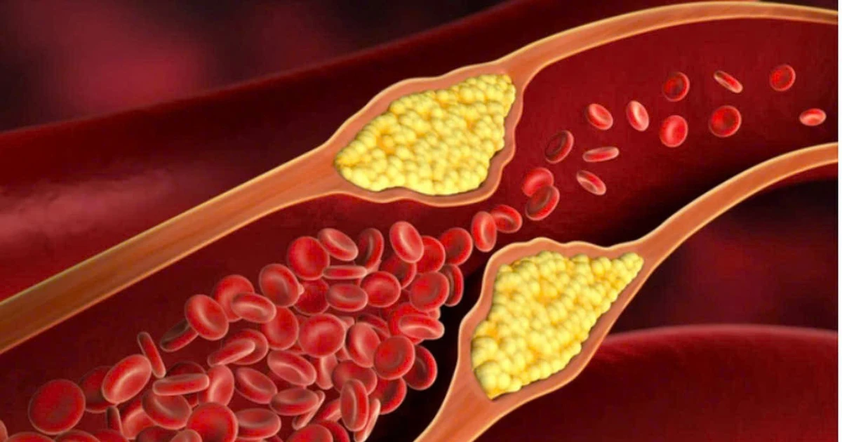 Đánh bay mỡ nội tạng sau 40 với chế độ ăn