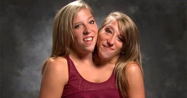 Cặp song sinh dính liền dùng chung một cơ thể suốt 34 năm giờ sống như thế nào?